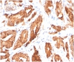 Recombinant PSA Antibody KLK3/4602R IHC staining of human prostate carcinoma. Immunohistochemistry analysis of FFPE human prostate carcinoma tissue using Recombinant PSA Antibody KLK3/4602R demonstrates strong HRP-DAB brown cytoplasmic staining in malignant prostate epithelial cells forming irregular glandular tumor structures, consistent with Prostate specific antigen (KLK3) expression in prostate-derived carcinoma. Surrounding stromal cells show little to no staining. HIER: tissue sections were boiled in pH 9 10mM Tris with 1mM EDTA for 20 minutes and allowed to cool before testing.