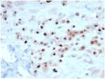 p57Kip2 Antibody Human Placenta Tissue IHC. Immunohistochemistry staining of FFPE human placenta tissue with recombinant p57Kip2 antibody (clone KIP2/7083R) at 2ug/ml in PBS for 30min RT. Negative control inset: PBS instead of primary antibody to control for secondary binding.