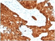 IHC staining of FFPE human ovarian carcinoma tissue with CDKN2A antibody (clone CDKN2A/7081R). HIER: boil tissue sections in pH 9 10mM Tris with 1mM EDTA for 20 min and allow to cool before testing.