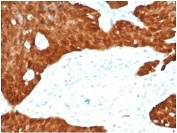 IHC staining of FFPE human ovarian carcinoma tissue with CDKN2A antibody (clone CDKN2A/7081R). HIER: boil tissue sections in pH 9 10mM Tris with 1mM EDTA for 20 min and allow to cool before testing.