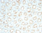 Cystic Fibrosis Transmembrane Regulator Antibody Salivary Gland IHC. Immunohistochemistry analysis of Cystic fibrosis transmembrane conductance regulator / CFTR expression in FFPE human salivary gland using recombinant rabbit monoclonal antibody clone CFTR/7154R. HRP-DAB brown staining is observed with apical membranous and luminal accentuation in ductal epithelial cells, while surrounding stromal cells show minimal signal; nuclei are counterstained blue. This CFTR antibody highlights epithelial ion channel localization consistent with secretory duct structures. Antigen retrieval was performed by boiling sections in 10 mM Tris buffer with 1 mM EDTA, pH 9, for 20 min followed by cooling at room temperature.