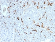Cystic Fibrosis Transmembrane Regulator Antibody Pancreas IHC. Immunohistochemistry analysis of Cystic fibrosis transmembrane conductance regulator / CFTR expression in FFPE human pancreas tissue using recombinant rabbit monoclonal antibody clone CFTR/7154R. HRP-DAB brown staining is observed with apical membranous and ductal localization in pancreatic epithelial cells, while surrounding acinar and stromal cells show minimal signal; nuclei are counterstained blue. This CFTR antibody highlights ion channel distribution consistent with pancreatic duct structures. Inset shows a PBS-only negative control processed without primary antibody, confirming minimal non-specific background staining. Antigen retrieval was performed by boiling sections in 10 mM Tris buffer with 1 mM EDTA, pH 9, for 20 min followed by cooling at room temperature.