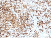 Immunohistochemistry analysis of PMEL17 antibody in human melanoma tissue. FFPE human melanoma sections show strong HRP-DAB brown cytoplasmic and membranous staining in tumor cells, consistent with premelanosome-associated localization of PMEL protein in melanocytic cells. Staining highlights clusters and sheets of melanoma cells, while adjacent stromal elements show minimal background signal. Heat induced epitope retrieval was performed in 10 mM Tris with 1 mM EDTA, pH 9.0, by boiling for 20 minutes followed by cooling prior to antibody incubation.