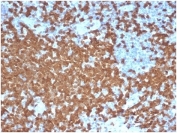 ZAP70 Antibody / Immunological Synapse Signaling Antibody. Immunohistochemistry analysis of formalin-fixed, paraffin-embedded human tonsil tissue using ZAP70 Antibody / Immunological Synapse Signaling Antibody (clone ZAP70/6492R). Antigen retrieval was performed by boiling sections in pH 9 Tris-EDTA buffer for 20 minutes followed by cooling. Cytoplasmic HRP-DAB brown staining is observed in densely packed lymphoid cells within tonsillar follicles, with clear contrast against adjacent lighter germinal center regions. The staining highlights clusters of interacting T lymphocytes consistent with Zeta-chain-associated protein kinase 70 (ZAP70) expression at sites of cell-cell contact, supporting its role in immunological synapse signaling and spatially organized T-cell activation within lymphoid tissue architecture.