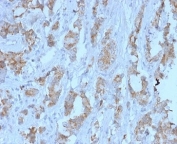 TDRKH Antibody Ovarian Carcinoma IHC. Immunohistochemistry analysis of Tudor and KH domain containing protein / TDRKH expression in FFPE human ovarian carcinoma tissue using TDRKH Antibody clone PCRP-TDRKH-1H2 at 2 ug/ml. The TDRKH Antibody shows cytoplasmic HRP-DAB brown staining in tumor cells with variable intensity, while surrounding stromal regions display reduced signal; nuclei are counterstained blue. Antigen retrieval was performed by boiling tissue sections in 10 mM Tris buffer with 1 mM EDTA, pH 9, for 20 min followed by cooling at room temperature.