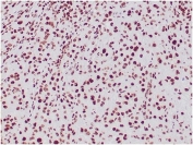 IHC staining of FFPE human epithelioid sarcoma with INI1 antibody (clone SMARCB1/3984). HIER: boil tissue sections in pH 9 10mM Tris with 1mM EDTA for 20 min and allow to cool before testing.