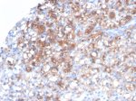 Recombinant HSP27 Antibody HSPB1/7038R Staining of Human Renal Cell Carcinoma IHC. Immunohistochemistry testing of FFPE human renal cell carcinoma tissue with Recombinant HSP27 Antibody clone HSPB1/7038R shows strong brown immunoreactivity in tumor cells, with a predominantly cytoplasmic staining pattern. HIER was performed by boiling tissue sections in pH 9, 10 mM Tris with 1 mM EDTA for 20 min followed by cooling before antibody testing.