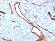 von Willebrand Factor Antibody / Angiogenesis Marker Antibody. Immunohistochemistry of human bone marrow shows HRP-DAB brown staining of endothelial cells lining sinusoidal vascular channels, forming elongated and branching vessel structures within the marrow microenvironment. The staining pattern highlights areas of vascular remodeling and endothelial expansion, with thin-walled sinusoids displaying irregular contours consistent with active angiogenic architecture. Clone VWF/4384R enables clear visualization of vessel distribution and organization within hematopoietic tissue. HIER: boil tissue sections in pH 9 10mM Tris with 1mM EDTA for 20 min and allow to cool before testing.