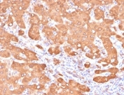 Aldehyde Dehydrogenase 1A1 Antibody Colon Carcinoma IHC. Immunohistochemistry staining of FFPE human colon carcinoma tissue with Aldehyde Dehydrogenase 1A1 antibody (clone ALDH1A1/4793). HIER: boil tissue sections in pH 9 10mM Tris with 1mM EDTA for 20 min and allow to cool before testing.
