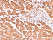 IHC staining of FFPE human colon carcinoma tissue with Aldehyde Dehydrogenase 1A1 antibody (clone ALDH1A1/4793). HIER: boil tissue sections in pH 9 10mM Tris with 1mM EDTA for 20 min and allow to cool before testing.