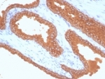 Recombinant Prostate Specific Antigen Antibody KLK3/7128R IHC staining of human prostate carcinoma. Immunohistochemistry analysis of FFPE human prostate carcinoma tissue using Recombinant Prostate Specific Antigen Antibody KLK3/7128R shows strong HRP-DAB brown cytoplasmic staining in malignant prostate epithelial cells forming glandular tumor structures, consistent with Prostate specific antigen (KLK3) expression in prostate-derived carcinoma cells, while surrounding stromal cells remain largely negative. HIER: tissue sections were boiled in pH 9 10mM Tris with 1mM EDTA for 20 minutes and allowed to cool before testing.