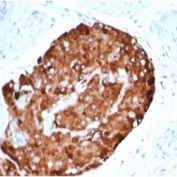 IINHA Antibody Recombinant Mouse MAb rINHA/6919 IHC staining of human testicular carcinoma. Immunohistochemistry analysis of FFPE human testicular carcinoma tissue using INHA Antibody Recombinant Mouse MAb rINHA/6919 at 2 ug/ml in PBS for 30 minutes at room temperature shows strong HRP-DAB brown cytoplasmic staining in tumor cells, consistent with Inhibin subunit alpha (INHA) expression in steroidogenic or sex cord related tumor cell populations, while surrounding stromal cells remain largely negative. HIER: tissue sections were boiled in pH 9 10mM Tris with 1mM EDTA for 20 minutes and allowed to cool before testing.