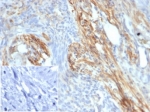 IHC staining of FFPE human bladder carcinoma tissue with PIK3 antibody (clone PIK3R2/292). Negative control inset: PBS used instead of primary antibody to control for secondary Ab binding.
