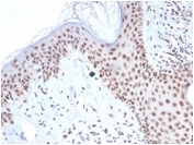 IHC staining of FFPE human basal cell carcinoma tissue with recombinant NPM1 antibody. HIER: boil tissue sections in pH 9 10mM Tris with 1mM EDTA for 20 min and allow to cool before testing.