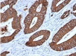 Pan Cytokeratin Antibody human colon IHC. Immunohistochemistry analysis of cytokeratin expression in FFPE human colon tissue using Pan Cytokeratin antibody clone MonoPoly/7249R. Strong cytoplasmic HRP-DAB brown staining highlights epithelial cells lining glandular structures, enabling rapid identification of epithelial compartments within the tissue while surrounding stromal elements remain negative. The staining pattern supports efficient epithelial screening and clear visualization of glandular architecture. HIER was performed by boiling tissue sections in pH 9 10 mM Tris with 1 mM EDTA for 20 minutes followed by cooling prior to antibody incubation.