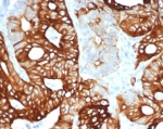 IKRT20 Antibody Recombinant Rabbit MAb KRT20/4380R. Immunohistochemistry analysis of FFPE human colon carcinoma tissue using recombinant rabbit monoclonal KRT20 antibody (clone KRT20/4380R). HRP-DAB brown chromogenic staining highlights cytoplasmic Keratin 20 / Cytokeratin 20 (KRT20) expression in malignant epithelial cells forming glandular structures, while surrounding stromal cells remain largely negative. The staining pattern reflects the known epithelial localization of this intermediate filament protein in colorectal carcinoma. HIER: boil tissue sections in pH 9 10 mM Tris with 1 mM EDTA for 20 min and allow to cool before testing.
