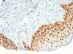 p40 Antibody for IHC. Immunohistochemistry analysis of Tumor protein p40 (deltaNp63) in FFPE human prostate cancer tissue using a p40 Antibody for IHC (clone P40/7302R) demonstrates strong HRP-DAB brown nuclear staining in basal epithelial cells at the periphery of glandular structures, while malignant luminal tumor cells remain negative. The staining forms a continuous basal layer pattern in residual benign glands, clearly delineating glandular architecture and highlighting loss of basal cells in carcinoma regions. The nuclear-restricted signal with minimal background supports accurate interpretation of deltaNp63 expression and epithelial compartmentalization. Heat-induced epitope retrieval was performed by boiling tissue sections in pH 9 10mM Tris with 1mM EDTA for 20 minutes followed by cooling prior to antibody incubation.