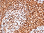 Vimentin Antibody / Cellular Plasticity Marker Antibody Tonsil IHC. Immunohistochemistry analysis of FFPE human tonsil tissue using Vimentin antibody shows strong HRP-DAB brown cytoplasmic staining in stromal and mesenchymal cell populations, with minimal staining in most lymphoid cells. The rabbit monoclonal clone VIM/6576R reveals heterogeneous staining intensity and filament organization across the tissue, with regions of dense, interconnected networks adjacent to areas of lighter, more diffuse cytoplasmic signal. This variability in staining pattern is consistent with differences in cellular state and supports the use of Vimentin as a marker of cellular plasticity within stromal compartments.