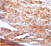 Desmin Antibody Human Uterus Tissue IHC. Immunohistochemistry staining of FFPE human uterus tissue using Desmin antibody (clone rDES/1711) demonstrates strong cytoplasmic staining throughout smooth muscle cell populations, consistent with the abundant expression of Desmin in contractile uterine tissue. Desmin is a type III intermediate filament protein that forms an essential component of the muscle cytoskeleton, helping maintain cellular architecture and mechanical integrity within smooth muscle cells. The widespread immunoreactivity observed within smooth muscle bundles is consistent with the established role of Desmin as a marker of muscle differentiation and smooth muscle tissue identity. Required HIER: boil tissue sections in 10mM citrate buffer, pH 6, for 10-20 min.