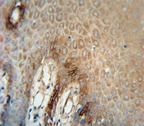 ITGA6 antibody immunohistochemistry analysis in formalin fixed and paraffin embedded human skin carcinoma.