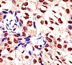 IHC analysis of FFPE human breast carcinoma tissue stained with the PRMT2 antibody