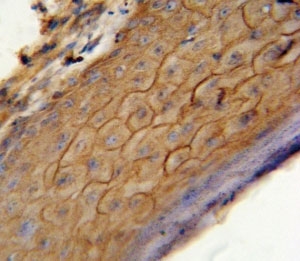 CB2 antibody immunohistochemistry analysis in formalin fixed and paraffin embedded human skin carcinoma.