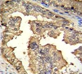 IHC testing of PRMT4 antibody and FFPE human prostate carcinoma.