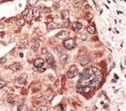 IHC analysis of FFPE human hepatocarcinoma tissue stained with the Recoverin antibody