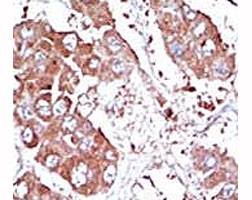 IHC analysis of FFPE human hepatocarcinoma tissue stained with the ALK3 antibody