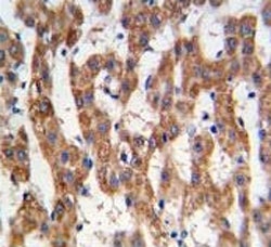 IHC analysis of FFPE human hepatocarcinoma tissue stained with PHB antibody