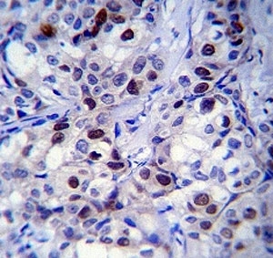 Rb antibody immunohsitochemistry analysis in formalin fixed and paraffin embedded human breast carcinoma.