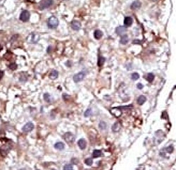 IHC analysis of FFPE human hepatocarcinoma tissue stained with the SPHK2 antibody.