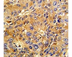 IHC analysis of FFPE human hepatocarcinoma with Cyclin A2 antibody