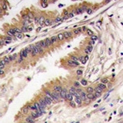 IHC analysis of FFPE human lung carcinoma tissue stained with ERK4 antibody