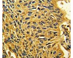 IHC analysis of FFPE human lung carcinoma stained with CDK2 antibody