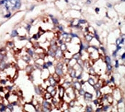 IHC analysis of FFPE human hepatocarcinoma tissue stained with the DYRKB antibody