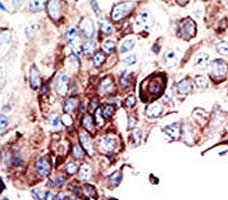 IHC analysis of FFPE human cancer tissue stained with the AXL antibody