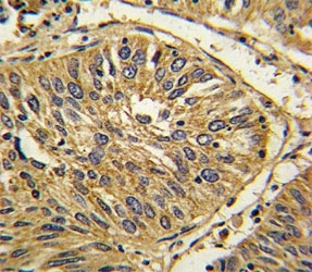 IHC analysis of FFPE human lung carcinoma with FGFR2 antibody