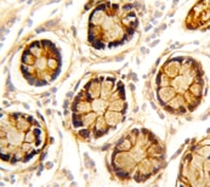IHC analysis of FFPE human colon carcinoma stained with PDGFRL antibody