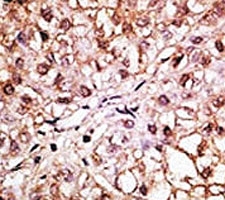 IHC analysis of FFPE human hepatocarcinoma tissue stained with the BNIP3L antibody