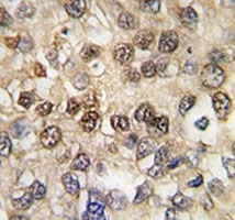 IHC analysis of FFPE human hepatocarcinoma tissue stained with RUNX2 antibody