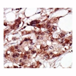 IHC analysis of FFPE human breast carcinoma tissue stained with the BRD4 antibody