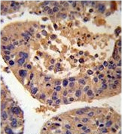 IHC testing of FFPE human hepatocarcinoma with AGXT antibody. HIER: steam section in pH6 citrate buffer for 20 min and allow to cool prior to staining.