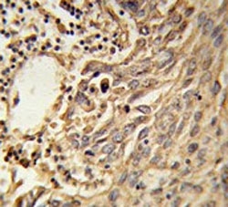IHC testing of FFPE human lung carcinoma tissue with EIF4A2 antibody. HIER: steam section in pH6 citrate buffer for 20 min and allow to cool prior to staining.