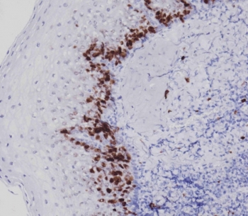 IHC testing of FFPE human tonsil tissue with Ki67 antibody. HIER: steam section in pH9 EDTA for 20 min and allow to cool prior to staining.