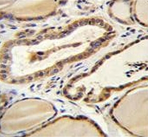 IHC testing of FFPE human thyroid tissue with Retinal guanylyl cyclase 1 antibody. HIER: steam section in pH6 citrate buffer for 20 min and allow to cool prior to staining.