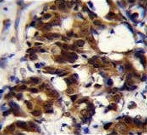 IHC testing of FFPE human breast carcinoma tissue with TRADD antibody. HIER: steam section in pH6 citrate buffer for 20 min and allow to cool prior to staining.