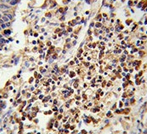 IHC testing of FFPE human lung carcinoma tissue with U2AF1 antibody. HIER: steam section in pH6 citrate buffer for 20 min and allow to cool prior to staining.