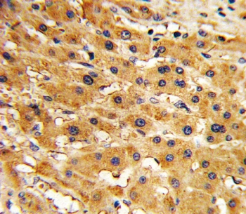IHC testing of FFPE human hepatocellular carcinoma tissue with Adenine phosphoribosyltransferase antibody. HIER: steam section in pH6 citrate buffer for 20 min and allow to cool prior to staining.