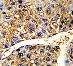 IHC testing of FFPE human hepatocellular carcinoma tissue with TUFM antibody. HIER: steam section in pH6 citrate buffer for 20 min and allow to cool prior to staining.